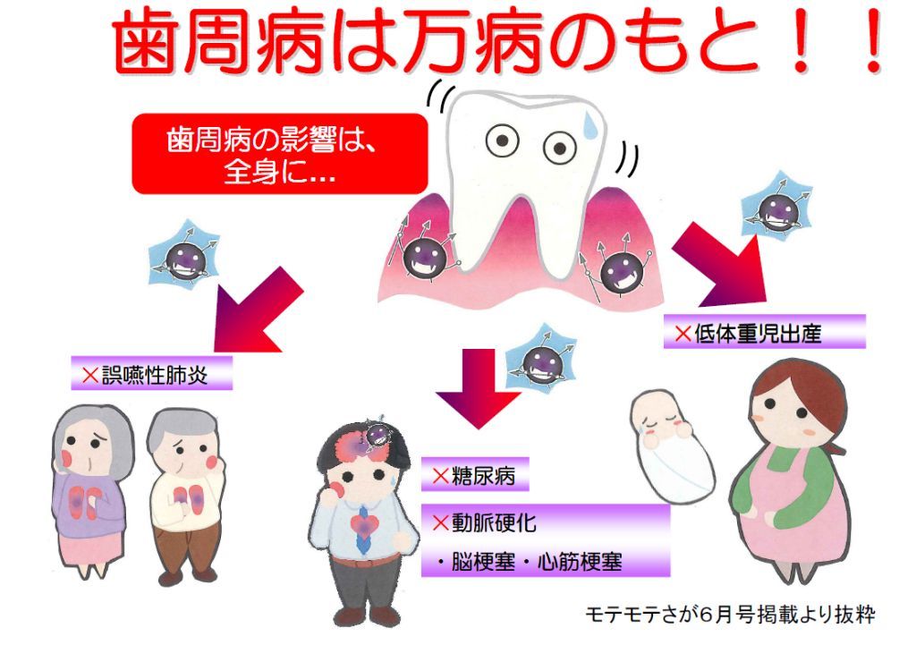 「歯周病は万病のもと！！」と赤文字で強調されたタイトルの下に、歯と歯茎のイラストがあり、周囲に歯周病菌のイメージが描かれ、その影響として「誤嚥性肺炎」「糖尿病」「動脈硬化・脳梗塞・心筋梗塞」「低体重児出産」などの病名が紫色の文字で示され、関連する人物や赤ちゃんのイラストが配置された歯周病の全身への影響を説明する図解イラスト